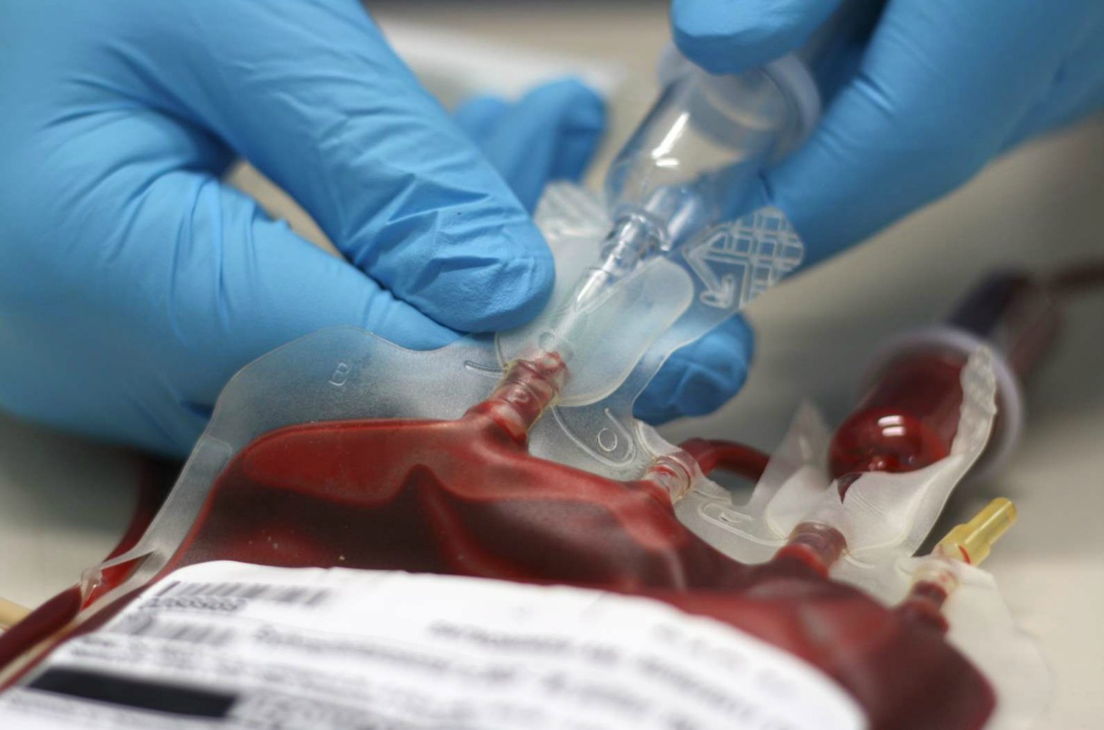 BeadChip Types Platelets for Better Transfusion Outcomes