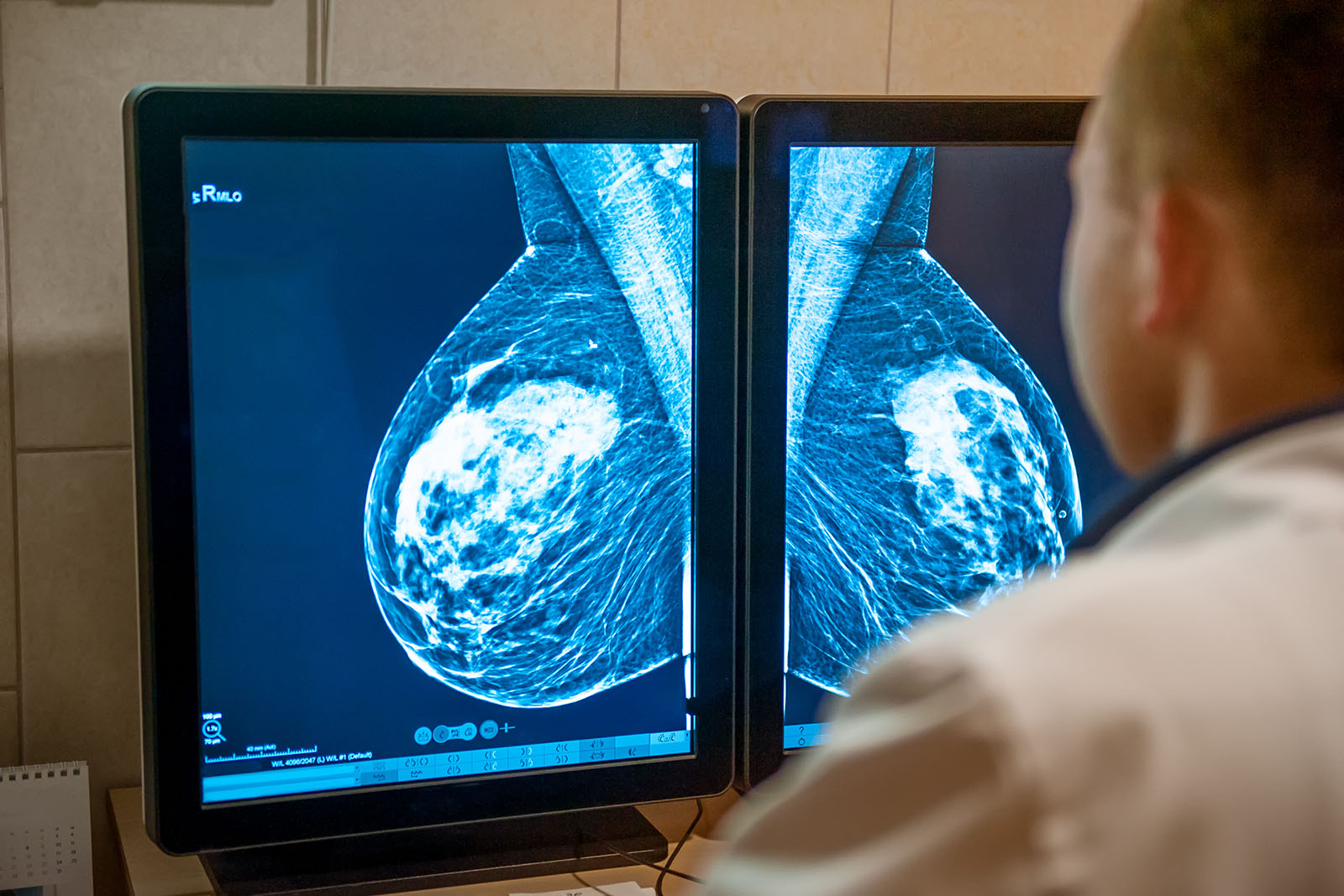 Mammogram Library from Cancer Research Horizons Helps AI Improve Diagnosis 
