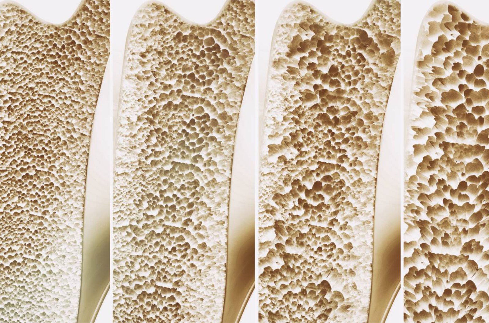 Early Detection and Improved Protection Against Osteoporosis 
