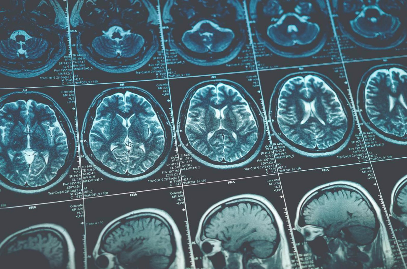 Finally, A Blood Test for Traumatic Brain Injury