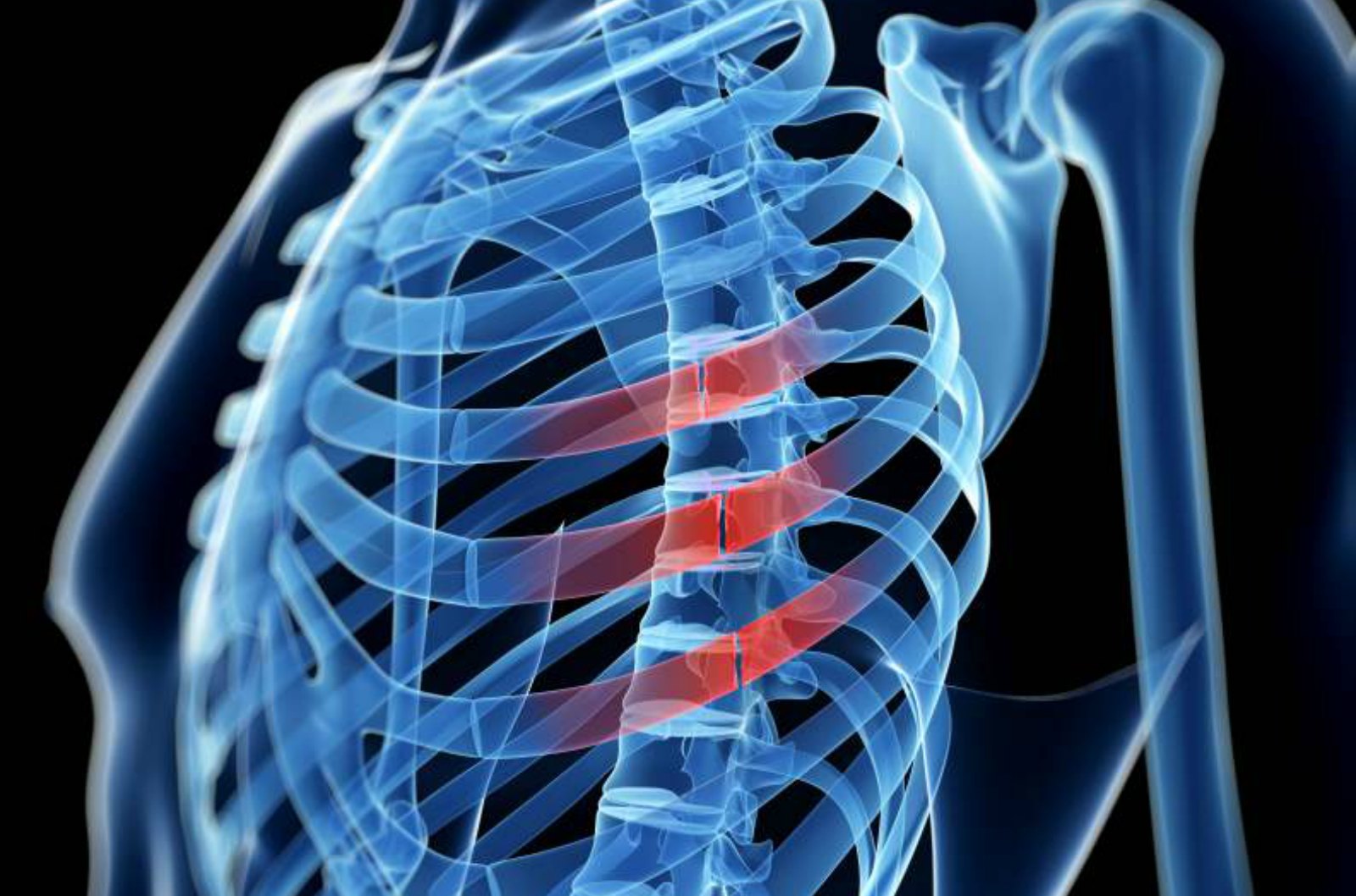 U-plate Eases the Pain of Broken Ribs